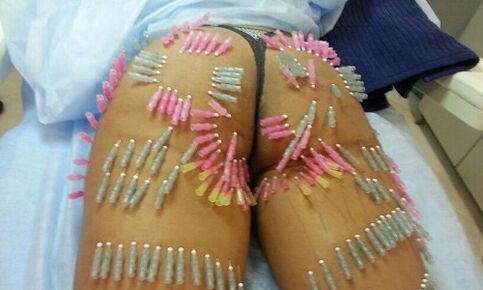 sollevamento del sedere